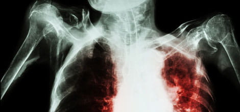 Avoiding TB diagnosis delays - The MDU